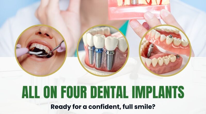 All on 4 dental implants