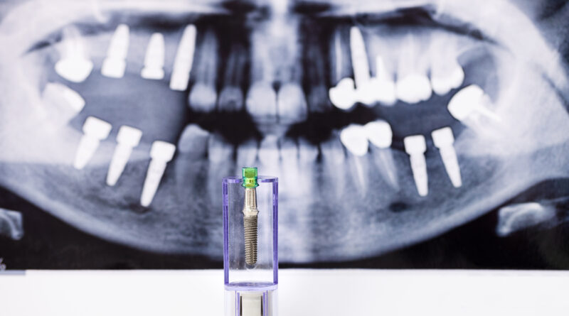 Dental implant specials